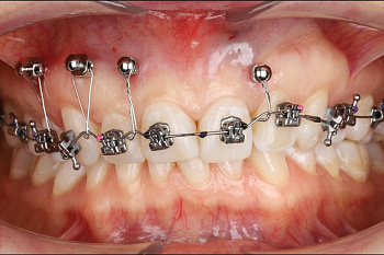 Функционально-эстетический оптимум  ортодонтического лечения